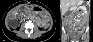 Abdominal CT scan – dilatation of intestinal segments, with circumferential, multisegmented mural thickening of over 3mm, affecting mainly the jejunum and descending colon, with associated submucosal oedema (“target sign” – arrow) and ascites (*). There is engorgement of mesenteric vessels and mesenteric fat stranding (curved arrows), suggesting vasculitis.