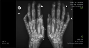 Radiografía de manos proyección posteroanterior: elongación de metacarpianos (aracnodactilia), signos degenerativos en interfalángicas distales y proximales (triángulos) y rizartrosis bilateral (asteriscos).