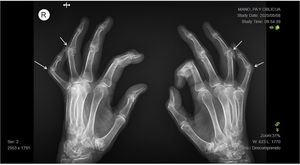 Radiografía de manos en proyección oblicua: contracturas en flexión de los dedos cuarto y quinto bilateral (flechas).