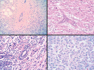 Los carcinomas lobulillares pleomórficos con diferenciación apocrina poseen rasgos histiocitoides, aunque se diferencian del carcinoma mioblastomatoide por su alto grado histológico. La figura ilustra el patrón de infiltración en diana y fila india, así como el gran tamaño nuclear con nucléolos prominentes.