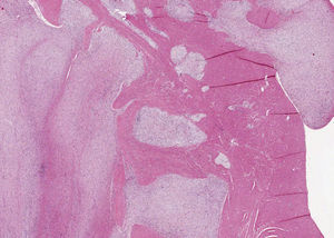 Imagen histológica del tumor. El tumor presenta un patrón de crecimiento plexiforme (40×).
