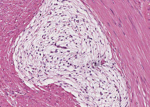 Las células tumorales son fusiformes y se disponen en el seno de una matriz mixoide (200×).