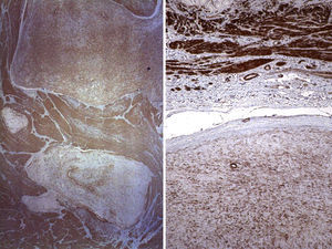 Resultados del estudio inmunohistoquímico. Las células tumorales expresan AML (izquierda) y caldesmón (derecha) (200×).