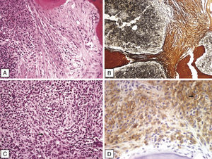 A) Médula ósea con presencia de fibrosis paratrabecular. Nótese la distribución en hileras de las células en la trama fibrosa (H&E, 200×). B) Fibrosis reticular y colágena puesta en evidencia con impregnación argéntica (100×). C) Foco de fibrosis con presencia de células voluminosas, flecha (H&E, 400×). D) Positividad para CD117 en las células voluminosas, flecha (400×).