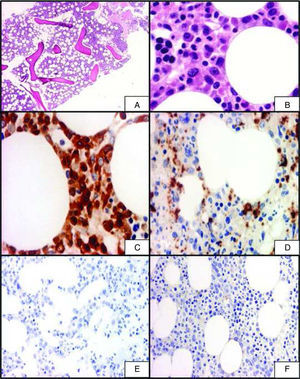 A) Sección de médula ósea en la que se observa una leve hipercelularidad (H&E, 4×). B) Ampliación de la microfotografía anterior en la que se aprecia una representación lineal normal con presencia de células histiocitarias (H&E, 40×). C) Inmunotinción para CD68 en la que se observan positivos los elementos histiocitarios (40×). D) Inmunotinción para PGM1: positividad en los histiocitos (40×). E) Inmunotinción para CD1a: negatividad en los elementos histiocitarios no-Langerhans (40×). F) Inmunotinción para S100 en la que se observa negativa la reacción en los elementos histiocitarios (40×).