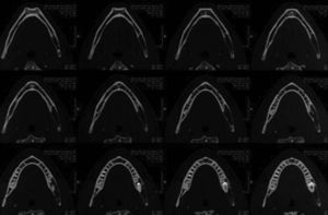 Área osteolítica multiloculada de la hemimandíbula izquierda con compromiso del tercer molar inferior izquierdo.