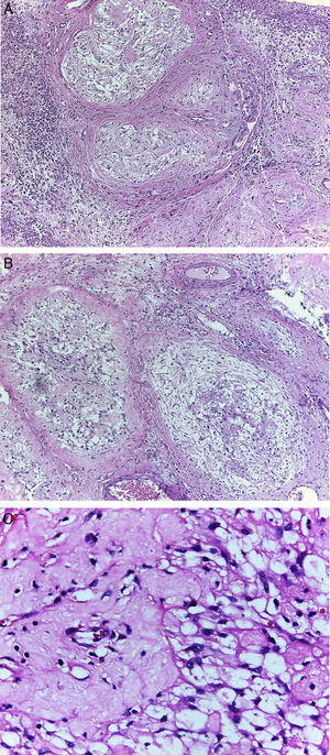 Caso clínico 2. A: tumor multinodular, con patrón de crecimiento reticular, rodeado por infiltrado inflamatorio (H-E, ×100). B: patrón de crecimiento reticular y áreas de aspecto mixoide (H-E, ×100). C: células fusiformes con núcleos redondos a ovales y amplio citoplasma eosinófilo, inmersos en abundante estroma colagenoso (H-E, ×400).