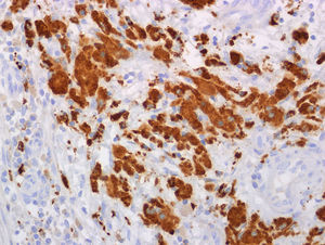 Caso 1. Histiocitos espumosos con inmunohistoquímica positiva para CD68 (×400).