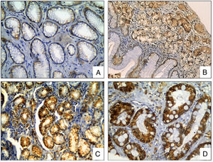 COX-2 Immunohistochemical staining in gastric biopsies with mucosal lesions. COX-2 staining was significantly higher in biopsies with H. pylori infection and areas with intestinal metaplasia. (A) normal gastric mucosa; (B) chronic gastritis; (C) chronic gastritis with H. pylori infection; (D) chronic gastritis with intestinal metaplasia (COX-2 IHC, original magnification ×400).