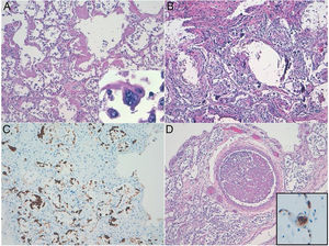 Diffuse alveolar damage (DAD) pattern of lung acute injury in COVID19. (a) Exudative phase showing hyaline membranes. Multinucleated pneumocyte with cytopathic-like changes. (b) Organizing-fibrotic phase of DAD, note the presence of calcification. (c) Desquamative pneumocytes highlighted with pankeratin stain. (d) Organized thrombus. Inset: CD61 expression in a septal capillary thrombus.