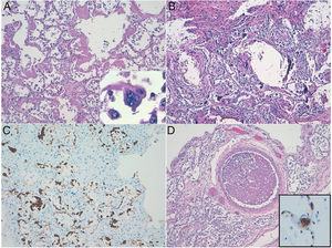 Diffuse alveolar damage (DAD) pattern of lung acute injury in COVID19. (a) Exudative phase showing hyaline membranes. Multinucleated pneumocyte with cytopathic-like changes. (b) Organizing-fibrotic phase of DAD, note the presence of calcification. (c) Desquamative pneumocytes highlighted with pankeratin stain. (d) Organized thrombus. Inset: CD61 expression in a septal capillary thrombus.