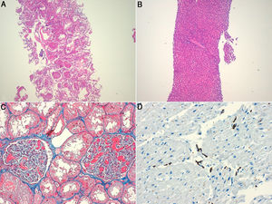 Aspecto microscópico del material obtenido. Pulmón con neumonía aguda fibrinosa en organización, HE (a); hígado con congestión sinusoidal, HE (b); riñón con congestión de los capilares glomerulares, tricrómico de Masson (c) y corazón con infiltrado histiocitario, inmunohistoquímica con CD68 (d).