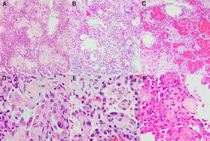 Histological study of the lung: (a and b) lung parenchyma with diffuse thickening of alveolar walls by inflammatory infiltrate and fibrosis (DAD pattern, proliferative/fibrotic phase) (H&E stain, 2×); (c) lung parenchyma with DAD pattern and frequent associated alveolar hemorrhage (H&E stain, 2×); (d–f) Alveolar walls coated by reactive pneumocytes and thickened by increased cellularity and fibrosis. Note the numerous vascular microthrombi (head of arrow) (H&E stain, 20×).