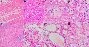 Histological study of other organs: (a) heart myocardium with necrotic myocytes (H&E stain, 20×); (b) hepatocytes with frequent glycogenated nuclei (H&E stain, 20×); (c) portal vascular microthrombus (H&E stain, 20×); (d) Hepatocytes with intense steatosis and enlarged nuclei (H&E stain, 40×); (e) Spleen with lymphocytic depletion of the white pulp and diminished lymphoid follicles (H&E stain, 4×); (f) Glomerular capillary microthrombus (H&E stain, 20×); (g) Tubular dilatation with flattened epithelium (H&E stain, 20×); (h) Vacuolization of tubular epithelium (H&E stain, 20×).