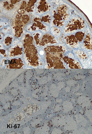 Expresión inmunohistoquímica para el antígeno epitelial de membrana (EMA) y Ki67 de predominio en la región basal de los lóbulos.