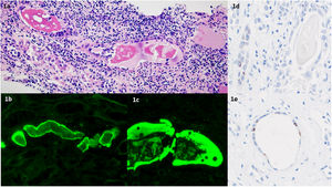 (a) Hematoxylin–eosin stain: hypereosinophilic casts in the distal nephron segments; interstitial inflammation with macrophages and mononuclear cells (H–E ×200). (b and c) Restricted light-chain immunofluorescence: Kappa-light chain immunofluorescence microscopy stains tubular casts. Lambda-light chain staining was negative (not shown). (d and e) Renal tubular epithelium positive for SARS-CoV-2 NP protein by immunohistochemistry (×400).