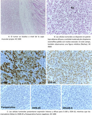 A: El tumor se localiza a nivel de la capa muscular propia. HE 100X. B: Las células tumorales se disponen en patrón tipo sábanas difusas y cantidad moderada de citoplasma eosinofílico pálido con núcleo vesicular. En este campo, también observamos una figura mitótica (flechas). HE 400X. C: Las células tumorales presentaron expresión intensa y difusa para S-100 y SOX-10, mientras que los marcadores melan-A, HMB-45 y panqueratina fueron negativos. HE 100X.