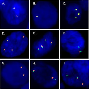 Patterns negatives and positives by FISH. Negative patterns for the presence of rearrangements. (A) Two fusions. (B) Deletion of the gene in one of the homologs. (C–E) Copy number gain. (F) Deletion of the 3′ extreme. Positive patterns for the presence of rearrangements. (G) Deletion of the 5′ extreme. (H and I) Short and long splits of the 3′ and 5′ extremes in one of the homologs.