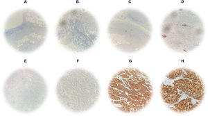 Protein expression by IHC. Technical controls of immunostaining in appendix specimens with mixed positive and negative patterns. (A and B) Immunostaining of non-specific antibodies at 10× and 40× optical resolution. (C and D) Immunostaining with D5F3 antibody at 10× and 40× optical resolution. ALK protein expression in lung adenocarcinoma with specific immunostaining by D5F3 antibody. (E and F) Negative cytoplasmic immunostaining at 10× and 40× optical resolution. (G and H) Positive cytoplasmic immunostaining at 10× and 40× optical resolution.