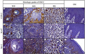 Immunohistochemical protein expression of COX-2, Ki-67 and Bcl-2. COX-2 protein expression in: A, Well-differentiated (WD) OSC; B, Moderately differentiated (MD) OSCC; C, Poorly differentiated (PD) OSCC; and D, Oral mucosa (OM). Ki-67 protein expression in: E, WD OSCC; F, MD OSCC; G, PD OSCC; and H, OM. Bcl-2 protein expression in: I, WD OSCC; J, MD OSCC; K, PD OSCC; and L, OM. (400×).