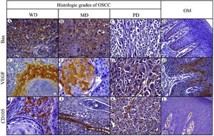 Immunohistochemical protein expression of Bax, VEGF and CD105. Bax protein expression in: A, Well-differentiated (WD) OSCC; B, Moderately differentiated (MD) OSCC; C, Poorly differentiated (PD) OSCC; and D, Oral mucosa (OM). VEGF protein expression in: E, WD OSCC; F, MD OSCC; G, PD OSCC and H, OM. CD105 protein expression in: I, WD OSCC; J, MD OSCC; K, PD OSCC; and L, OM. (400×).