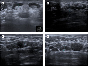 (A) Initial ultrasound scan. Adenopathy at Berg's level I and II (UN3, cortical thickness >2.3mm) reaching up to 5mm cortical thickness, with reactive features. (B and C) Follow-up ultrasound scan 6 weeks after first dose. Adenopathy of inflammatory aspect in both axillary regions. The larger ones (UN3) are in level II of Berg in the left axilla and in level I of the right axilla. (D) Ultrasound scan (more than six weeks after the second dose). Increase in the number and size of the left adenopathy in the three axillary levels of Berg. A core needle biopsy was requested.