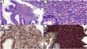 Colonic adenomatous polyp with florid presence of monoclonal lambda ...