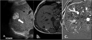 Ultrasound reported a hyperechogenic indeterminate solid lesion in segment VII measuring 26mm×22mm (a). For a better characterization of this lesion, simple and contrast MRI of the abdomen was performed, which showed the nodule as hypervascular with intralesional fat (b and c). These findings in the context of a non-cirrhotic liver were interpreted as an adenoma.