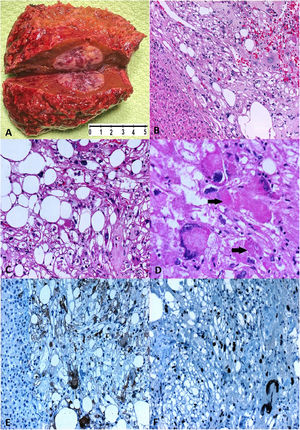 Hepatic pleomorphic liposarcoma. (A) A white-yellow, relatively firm (2.2cm×2cm×1.5cm) nodular tumour on a hepatic segment. (B) A well-circumscribed, non-encapsulated tumour with infiltrative borders [HE 10×]. (C) Classic lipoblasts with scalloped nuclei or signet ring lipoblasts [HE 40×]. (D) Pleomorphic lipoblasts in a high-grade background with varying numbers of pleomorphic and frequently bizarre multinucleated tumour cells with intra-cytoplasmic “thanatosomes” (black arrows) [HE 40×]. (E) Diffuse cytoplasmic and nuclear S100 expression in tumour cells [20×]. (F) Diffuse p53 nuclear expression in tumour cells [40×].