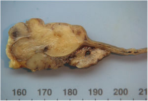 A lobular and white-grey tissue developed in the wall of the ileum, surrounding a small slit (arrow).