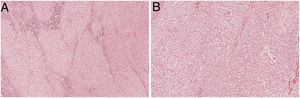 Extraskeletal myxoid chondrosarcoma. (A) The lesion had a multinodular pattern with a mild myxoid background and necrosis (upper left), H&E 20×. (B) In the most cellular areas, the cells have a more undifferentiated phenotype, with pronounced atypia and irregular nuclear membrane with visible nucleoli, H&E 200×.