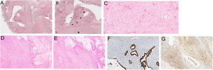 (a) The slit corresponded to a diverticulum mainly with ileal type mucosa lining, H&E20×. (b) Some heterotopic gastric type glands were also present (arrowheads) and foci of dysplasia (arrow). The majority of the diverticulum was affected by the extraskeletal myxoid chondrosarcoma (EMC) (star). (c) (Inlet) – heterotopic gastric type glands. (d) Both tumours are present, the EMC and the adenocarcinoma, H&E100×. (e) The adenocarcinoma (right) was in close relation with the EMC (left), in an intermingled pattern, H&E 150×. (f) Pancytokeratin Cam5.2 staining the adenocarcinoma. The EMC does not show any staining. H&E 150×. (g) Vimentin stains the EMC, the malignant glands do not show any staining (EMC – extraskeletal myxoid chondrosarcoma).