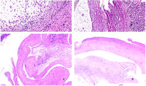 A) Mucocele. Material mucoide y mucífagos de citoplasma amplio y microvacuolado en la luz de un mucocele (Hematoxilina-eosina x400). B) Mucocele. A la izquierda de la imagen se observa la luz del mucocele; en el centro, la pared con inflamación, fibrosis e incremento de vascularización; a la derecha, la glándula salival menor (Hematoxilina-eosina x200). C: Ganglión. Esta zona muestra un área de degeneración mucinosa del tejido conectivo. Como resultado de dicha degeneración, se forman cavidades irregulares sin revestimiento epitelial (Hematoxilina-eosina x40). D) Ganglión. En esta área cavitada se observa abundante contenido mucoide (Hematoxilina-eosina x40).