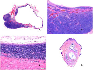 A) Imagen panorámica de un quiste branquial con una cavidad revestida por epitelio escamoso con abundante tejido linfoide asociado (Hematoxilina-eosina x20). B) Pared del quiste en la que se identifica tejido linfoide con folículos y centros germinales (Hematoxilina-eosina x40). C) Detalle donde se reconoce la pared fibrosa revestida por epitelio escamoso con una banda de tejido linfoide subyacente (Hematoxilina-eosina x100). D) Quiste onfalomesentérico. Vista panorámica. Lesión vertical de aspecto quístico de contenido mucoide (Hematoxilina-eosina x20).