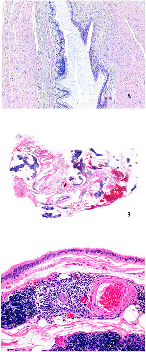 A) Quiste onfalomesentérico. Pared revestida por epitelio intestinal y foveolar con músculo alrededor (Hematoxilina-eosina x100). B) Quiste tímico. Se observa una estructura quística multilocular con múltiples focos linfoides (Hematoxilina-eosina x20). C) Quiste tímico. El revestimiento epitelial de este caso era cilíndrico ciliado monocapa. En la pared del quiste se observan restos linfoides, así como un corpúsculo de Hassall (Hematoxilina-eosina x100).