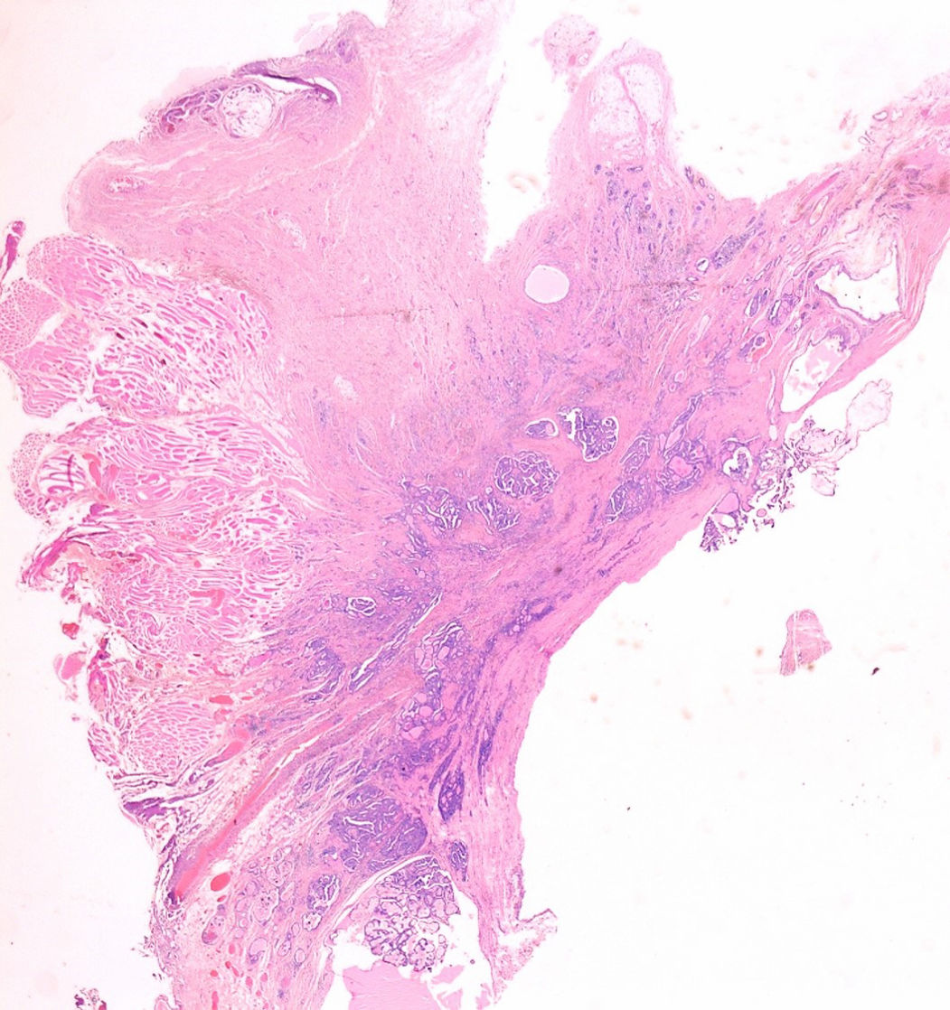 Papillary carcinoma in thyroglossal duct cyst: A case report | Revista ...