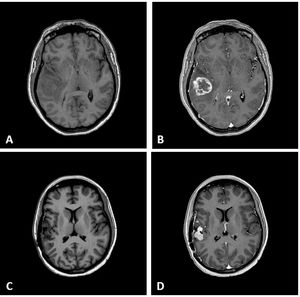 Magnetic resonance imaging (MRI). (A) Pre-operative axial T1-weighted MR image without gadolinium enhancement. (B) Pre-operative axial T1-weighted MR image with gadolinium enhancement. (C) Axial T1-weighted MR image without gadolinium enhancement, prior to the second surgery. (D) Axial T1-weighted MR image with gadolinium enhancement, prior to the second surgery.