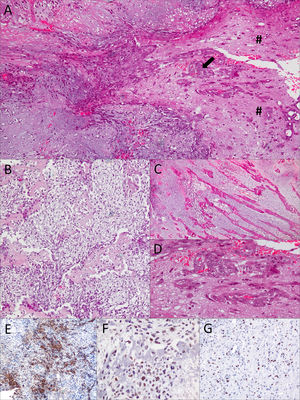 Gliosarcoma with osteosarcomatous component. (A) Glial component (#) with marked atypia and focal vascular proliferation (black arrow). (B) Osteoid islands interspersed between fusocelular population. Spindle cell, chondroid, and osteocyte areas exhibited nuclear atypia and high mitotic activity. (C) Osteoid islands with central chondroid appearance were clearly defined. (D) Endovascular proliferation and atypical glial cells. (E) GFAP immunohistochemical expression in the glial component. (F) MDM2 immunohistochemical nuclear expression. (G) Ki67 immunohistochemical expression at nuclear level (proliferative index: 50%).