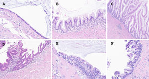 Typical architectural features of LAMN. (A) This LAMN case shows flat epithelial growth (H&E, 40×). (B) A LAMN case with an undulating pattern (H&E, 40×). (C) A LAMN case with a villous pattern (H&E, 20×). (D) A HAMN showing the presence of cribriform structures (H&E, 40×). (E) A HAMN case with multilayered epithelial growth (H&E, 40×). (F) A HAMN case with presence of micropapillary structures (H&E, 40×).