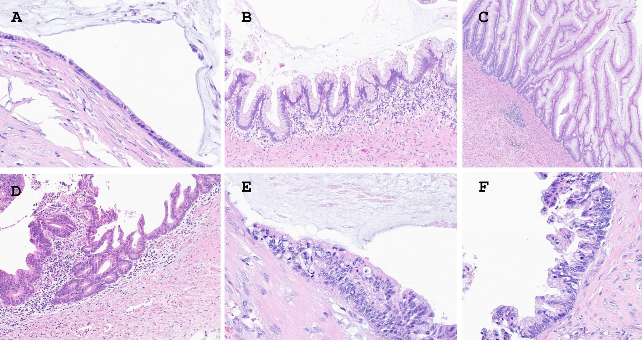 Morphological and clinical predictive factors in appendiceal mucinous ...