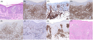 Histopathological and immunohistochemical findings in early-stage mycosis fungoides. (A) H&E of a classic patch showing epidermotropism without spongiosis. (B) Clonal TCRB expression in the epidermal and dermal infiltrate (10×). (C) Predominance of CD4+ T cells within the epidermis (20×). (D) Preservation of CD5 expression (10×). (E) Partial loss of CD7, typical of cutaneous T-cell lymphoma (10×). (F) CXCL13 positivity in a dermal subpopulation consistent with a TFH-like phenotype (10×). (G) PD-1 highlighting activated/TFH-like T cells in the epidermis (10×). (H) H&E of folliculotropic MF showing characteristic perifollicular infiltrates and follicular destruction.