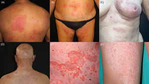Representative clinical presentations relevant to the diagnosis and differential diagnosis of early-stage mycosis fungoides. (A) Patch-stage MF with multiple faint erythematous patches involving the trunk and proximal extremities. (B) Classic MF plaque with well-demarcated erythematous, scaly lesions. (C) Folliculotropic MF presenting with grouped follicular papules and perifollicular infiltrated plaques. (D) Comedonal folliculotropic MF characterised by follicular plugging and comedone-like lesions on the trunk. (E) Urticarial plaques with central clearing and an annular configuration, predominantly affecting intertriginous areas. (F) Hypopigmented MF.
