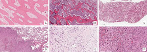 Morphological features of cases successfully analysed (D, E, F) and cases that did not meet analysis criteria (A, B, C). A, Parosteal OS decalcified in nitric acid. B, Parosteal OS decalcified in EDTA. C, Conventional OS, non-decalcified, from 2016. D, Pulmonary metastasis of conventional OS. E, Extraskeletal OS, non-decalcified. F, Conventional OS, non-decalcified.
