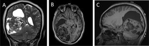 Contrast-enhanced magnetic resonance imaging: (A) T1-weighted sections and (B and C) T2-weighted sections. Large, heterogeneous intra-axial lesion in the right cerebral hemisphere with mass effect, mild vasogenic oedema, no diffusion restriction, and areas of calcification or haemorrhage.