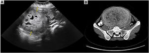 (A) Longitudinal abdominal ultrasonography section showing a uterine mass measuring 12.9cm in its greatest diameter. (B) Contrast-enhanced computed tomography demonstrating a large, solid, heterogeneous uterine mass, suspicious for fibroid with cystic degeneration.
