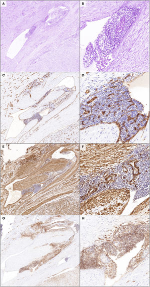 (A, B) Smooth muscle cells along with nests of endometrial-type stroma within a vessel adjacent to a leiomyoma. No necrosis or atypia is observed. (C, D) CD31 immunostaining highlights the endothelium of this vessel within the thickness of the spared myometrium. (E–H) Caldesmon (E, F) and CD10 (G, H) show strong positivity in smooth muscle cells and endometrial stroma, respectively.