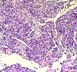 Haematoxylin and eosin (H&E), ×10. Malignant vascular neoplasm with an irregular infiltrative architecture, composed of anastomosing vascular channels and solid areas, showing marked endothelial atypia.