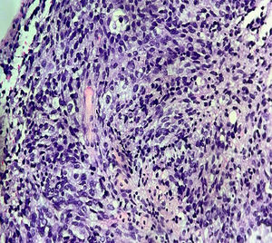 Haematoxylin and eosin (H&E), ×40. Marked tumour hypercellularity with proliferation of large polygonal cells showing abundant eosinophilic cytoplasm and a solid growth pattern, consistent with epithelioid morphology.