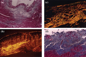 (a) inflammatory infiltrate areas highly suggestive of a myocardial infarct in the subendocardial region of a hypertensive heart (magnification 100X); (b) postinfarct fibrotic areas in the right ventricular myocardium of a hypertensive animal, stained with picrosirius red using polarized light to show fibrillar collagen (in yellow, orange, or red) occupying a great proportion of collagen fibers (magnification 200X); (c) postinfarct fibrotic areas in the myocardium of a hypertensive animal, showing fibrillar collagen (in yellow, orange, or red) corresponding to a high proportion of collagen, with a small amount of reticular collagen (in green) (magnification 200X) (picro-sirius-red polarization).