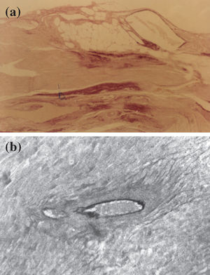 (a) Myocardium with intense reaction by oxytalan fibers (dark dots) of the elastic system in reparative fibrotic areas (Weigert's resorcinol-fuchsin method using an oxone reaction; magnification 100X); (b) perivascular fibrosis characteristic of the hypertensive cardiac processes using the L-NAME model. Note the degeneration of the inner elastic lamina and lack of reaction for oxytalan fibers of the elastic system (Weigert's resorcinol-fuchsin solution with oxone; magnification 200X).